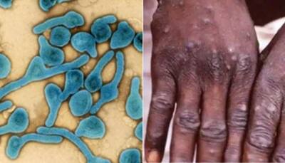 Monkeypox vs Marburg virus: Which one is more DEADLY? Which spreads faster? - Details here