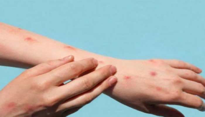 Monkeypox in India: Health department in Karnataka's Dakshina Kannada sounds alert, Kerala  starts testing at Alappuzha NIV lab