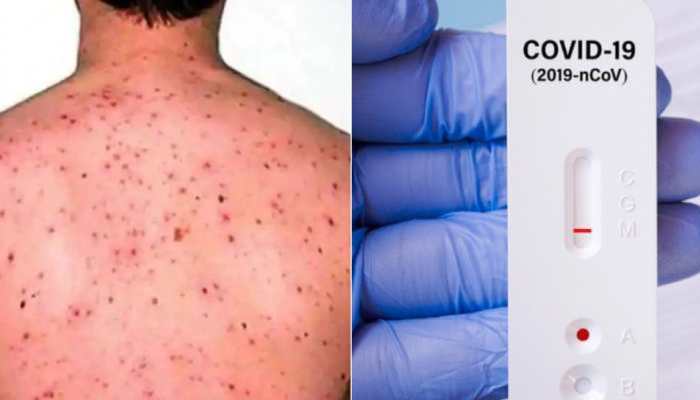 Can you get Covid-19 and Monkeypox at same time? Double-infected US man recalls 'horrible' ordeal