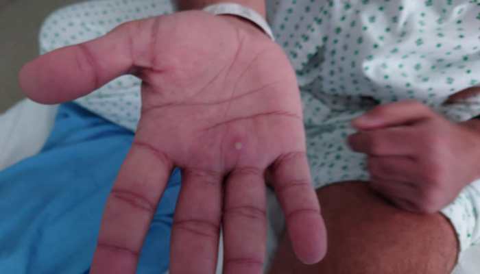 Monkeypox virus reaches Delhi, India's fourth case confirmed in a 34-year-old man - Details here