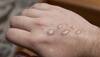 monkeypox virus vaccine
