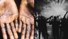 Monkeypox-infected Delhi man attended 'stag party' in Manali: Sources