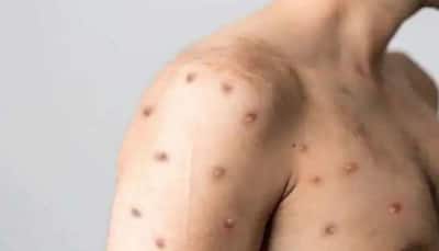 Monkeypox in India: Suspected case in Himachal; Delhi patient had visited state for 'stag party'