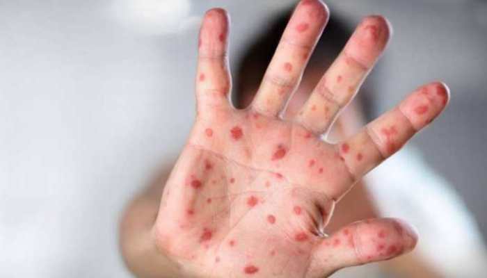 India's first Monkeypox-infected person recovers; check his health update here
