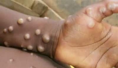 Monkeypox hits children? 8-year-old in Andhra found with suspected symptoms