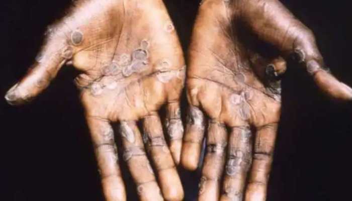 After youth with Monkeypox symptoms dies in Kerala, Centre forms task force to monitor situation in India