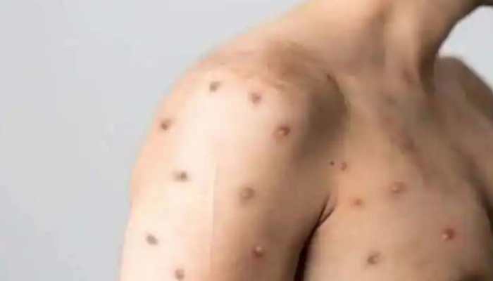 Delhi records 5th Monkeypox case as 22-year-old woman tests positive