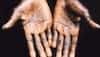 WHO says Monkeypox vaccines efficacy below 100 per cent