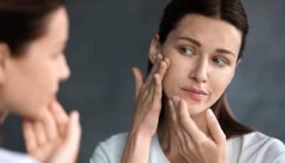 Don't pop that zit: 10 effective home remedies for acne