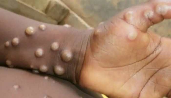 Nigerian woman tests positive for monkeypox in Delhi, India&#039;s tally rises to 13