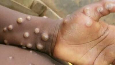 Nigerian woman tests positive for monkeypox in Delhi, India's tally rises to 13
