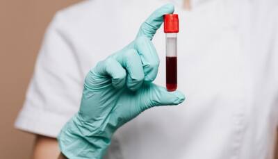 Blood tests might help to detect long covid in patients, suggests research