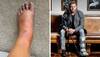 Jonny Bairstow shares freak injury photos, rules himself out until 2023