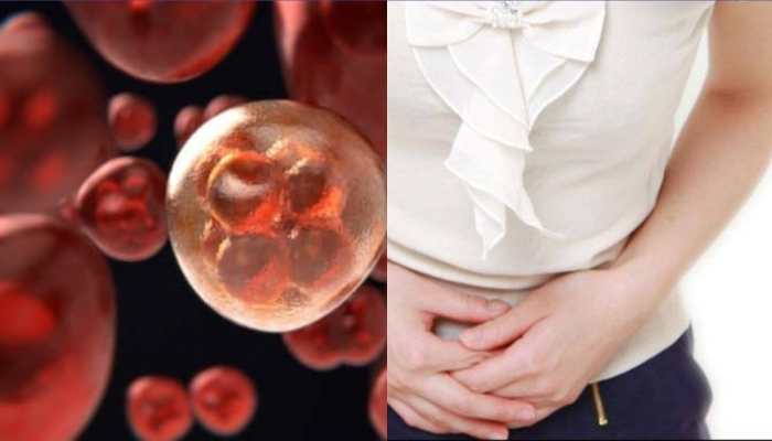 Novel treatment effective for bladder cancer: Study