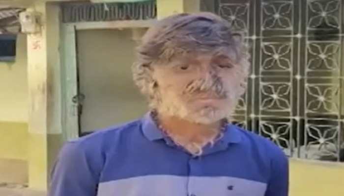 Video of teenage boy with 'werewolf syndrome' goes viral: WATCH