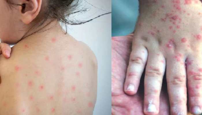 Measles outbreak wreaks havoc in Mumbai, 16 dead, over 500 cases in three months