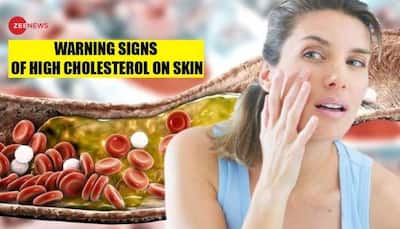 High cholesterol signs: Can high cholesterol affect your skin? Tips to manage and lower your cholesterol