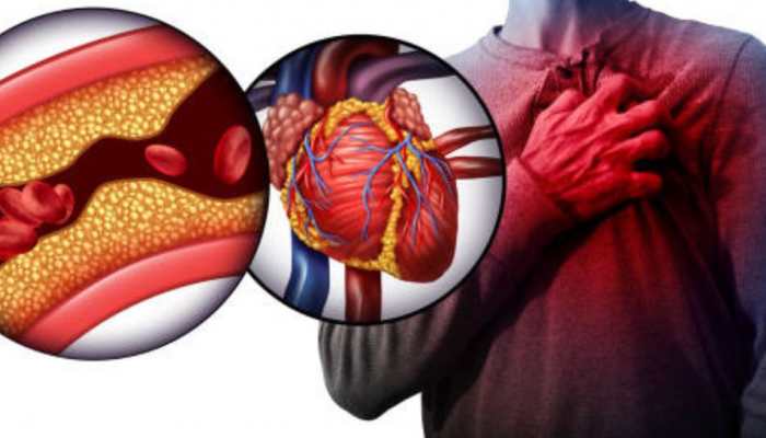 Dark Chocolate to Fatty Fish: Check 7 Foods That Can Help You Prevent Clogged Arteries