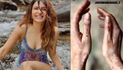 Samantha Ruth Prabhu Injured On Sets Of Citadel, Shares Pic Of Bruised Hands