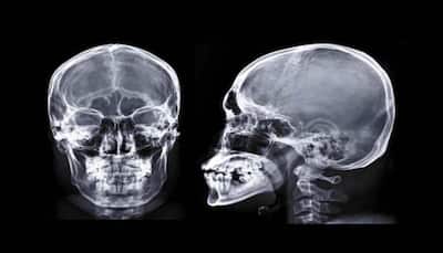 Men Are More Likely Than Women To Suffer From A Skull Fracture: Study
