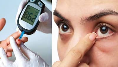 EXCLUSIVE: Diabetic Retinopathy: Can High Blood Sugar Cause Blindness - Check Expert's Advice