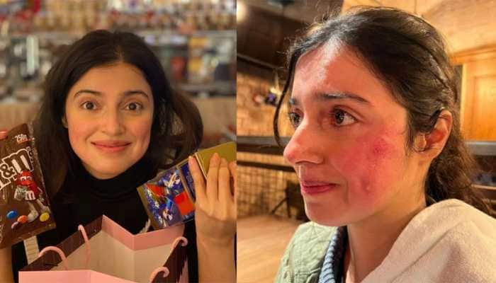 Divya Khosla Kumar Gets Injured On Sets Of Yaariya 2, Drops Photos