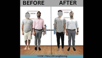 Limb Lengthening made easy – Height Increase Info provides an effective way to add a few more inches to your height 