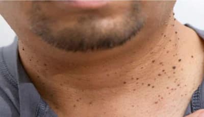 Warts: Expert Explains Causes And Preventive Measure To Take Care Of Your Skin