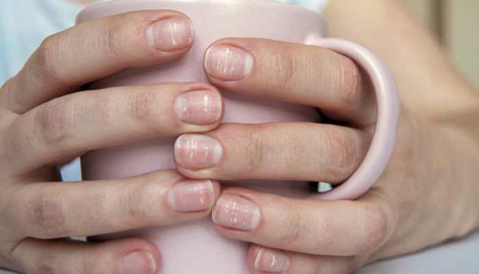 Close Woman's Nails Poor Manicure Cuticle Overgrown Nails Damaged Nail  Stock Photo by ©ankuznetsova 370819482