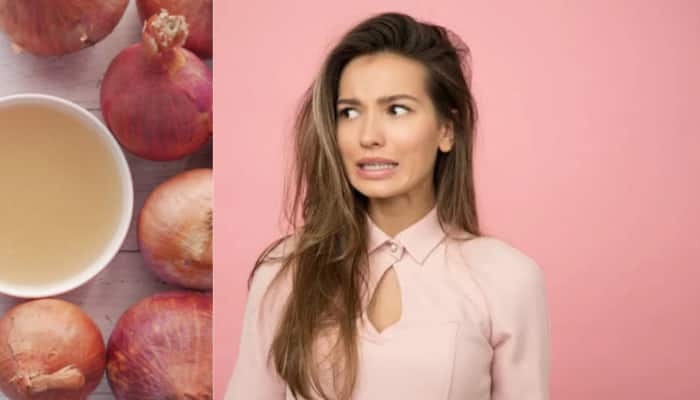 Summer Haircare: Can Onion Help Control Hair Fall? Here Are Facts