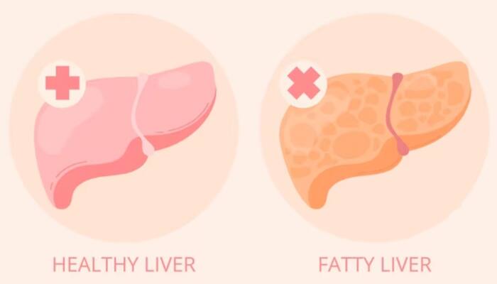 Reverse Fatty Liver: 5 Effective Home Remedies To Enhance The Healing Process