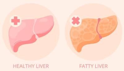 Reverse Fatty Liver: 5 Effective Home Remedies To Enhance The Healing Process