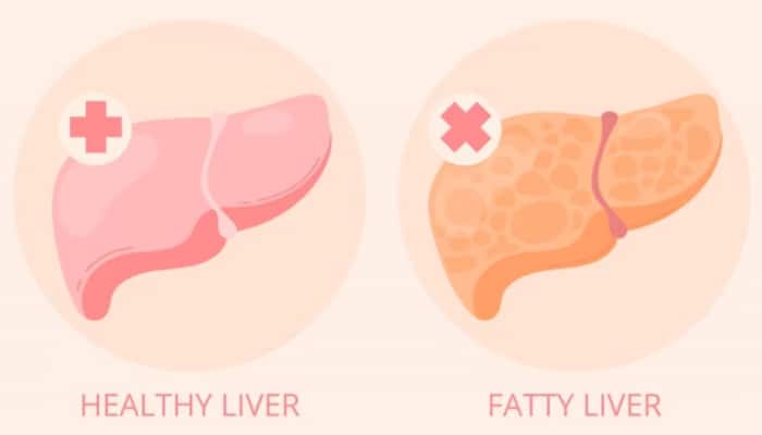 Reverse Fatty Liver: 5 Effective Home Remedies To Enhance The Healing Process