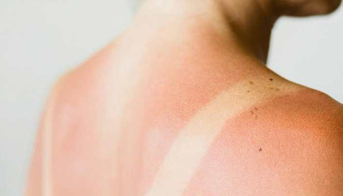 Sunburns Got You Down? Here Are 5 Simple And Effective Home Remedies For Summer Protection