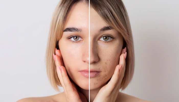 Exclusive: 9 Ways To Prevent Acne After Gym Workouts 