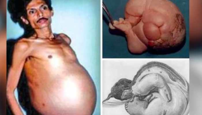 Rare! This Nagpur Man Was &#039;Pregnant&#039; For 36-Years With Twins - Know Surprising Story