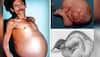 Fetus in fetu