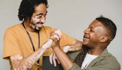 World Vitiligo Day 2023: Causes, History, And Significance 