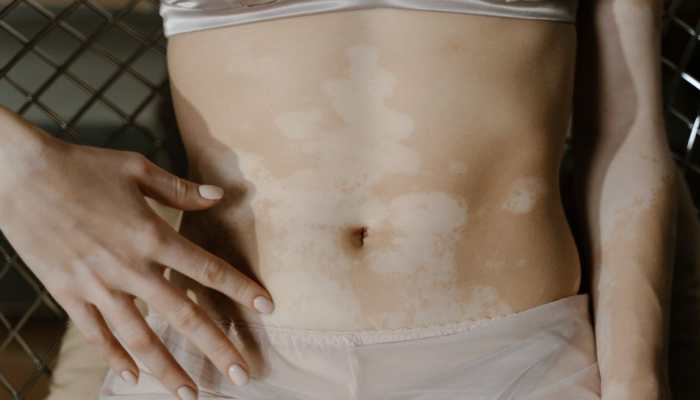 Vitiligo: Will Your Child Have White Patches On Skin - Expert Busts 8 Common Myths