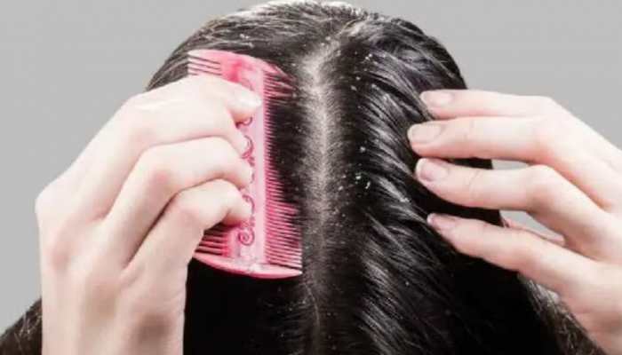 How To Get Rid Of Dandruff? Expert Shares 6 Tips To Treat Flakes During Monsoon How To Get Rid Of Dandruff? Expert Shares 6 Tips To Treat Flakes During Monsoon