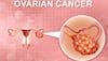 Why Hairdressers, Beauticians, Accountants Are At High Risk Of Ovarian Cancer? Study Reveals