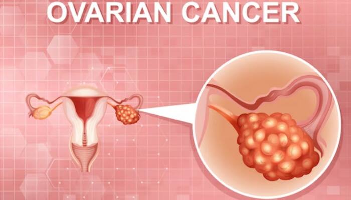 Why Hairdressers, Beauticians, Accountants Are At High Risk Of Ovarian Cancer? Study Reveals
