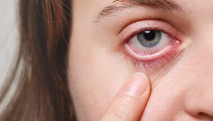 Conjunctivitis: Doctors See 40% Rise In Viral Pink Eye Cases Among Kids, Adults