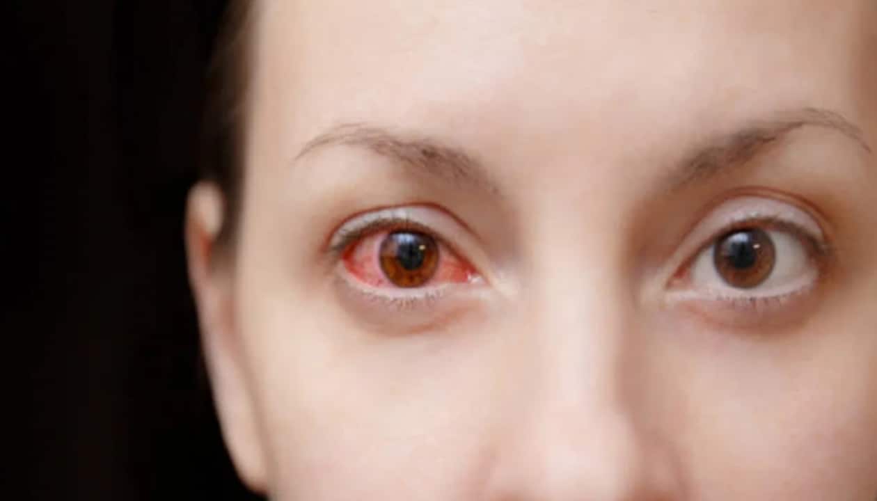 Monsoon Eye Health: Can You Catch The Flu By Peering Into Someone Else's Eyes?