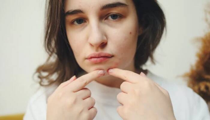 Acne Myths: 6 Pimple Popping Misconceptions Busted!