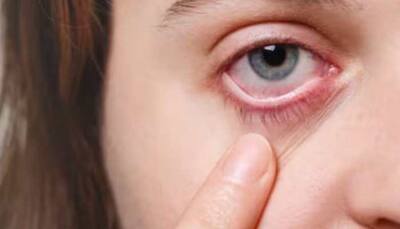 Eye Flu Cases On Rise In India: 10 Tips To Keep Your Kids Safe From Conjunctivitis