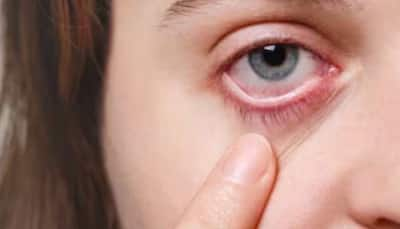 Conjunctivitis Eye Care Tips: Expert Shares Risks, Types And Prevention