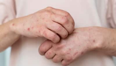 Psoriasis Awareness Month 2023: Identifying Environmental And Lifestyle Factors That Aggravate Symptoms Of This Autoimmune Disease