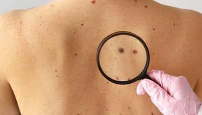 Men More Likely To Develop ‘Melanoma’ Skin Cancer? Here’s What Study Claims 