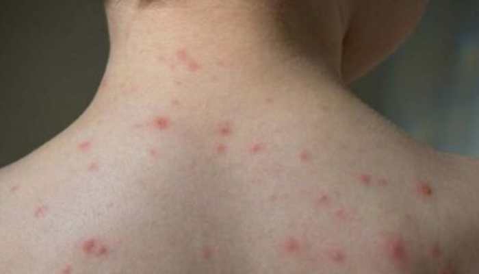 What Is Varicella-Zoster Virus? Check Symptoms And Preventive Measures To Follow 